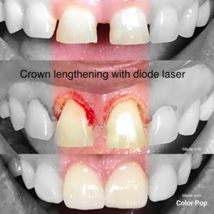 Crown Lengthening With Diode Laser