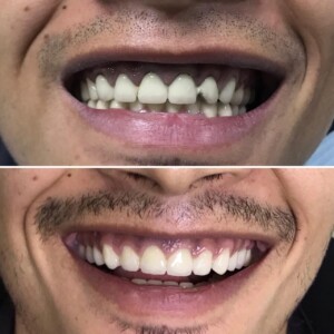 Full Mouth Rehabilitation With Emax Restorations