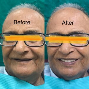 Full Mouth Rehabilitation With Complete Dentures