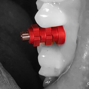 Implant Impression Post ! Ready To Make Impression