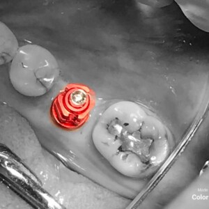 Impression Post For Tissue Level Dental Implant