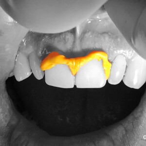 Impression technique developed by Dr Bhusal. Gingival retraction using provisional restorations and putty