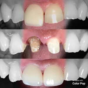 Metal Free Anterior Restorations