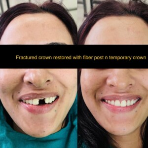 Fractured Crown Restoration With Fiber Post and Temporary Crown