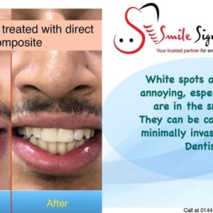 White Spots Treated with Direct Composite