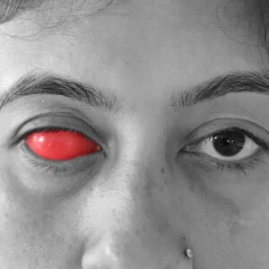 Wax eyeball trial for eye prosthesis