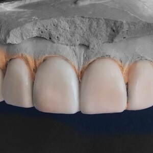 Wax mockup for esthetic restorations
