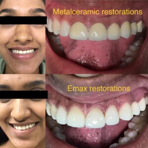 Metal Ceramic Restorations